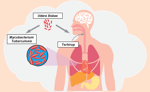 Tuberkulosis (TBC): Gejala, Penyebab dan Cara Mengobatinya