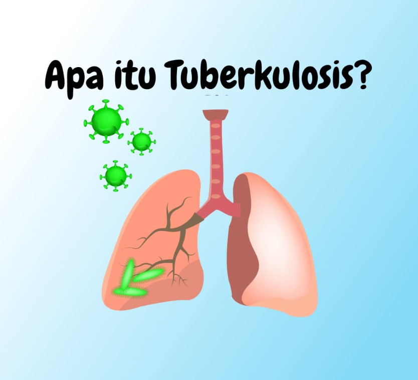 Apa Itu Penyakit TBC? Gejala, Penyebab, dan Cara Mencegahnya